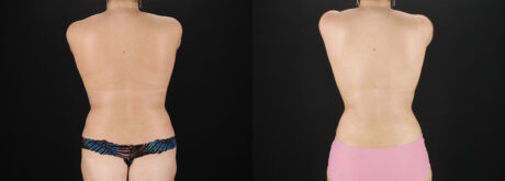 Liposuction case #6120