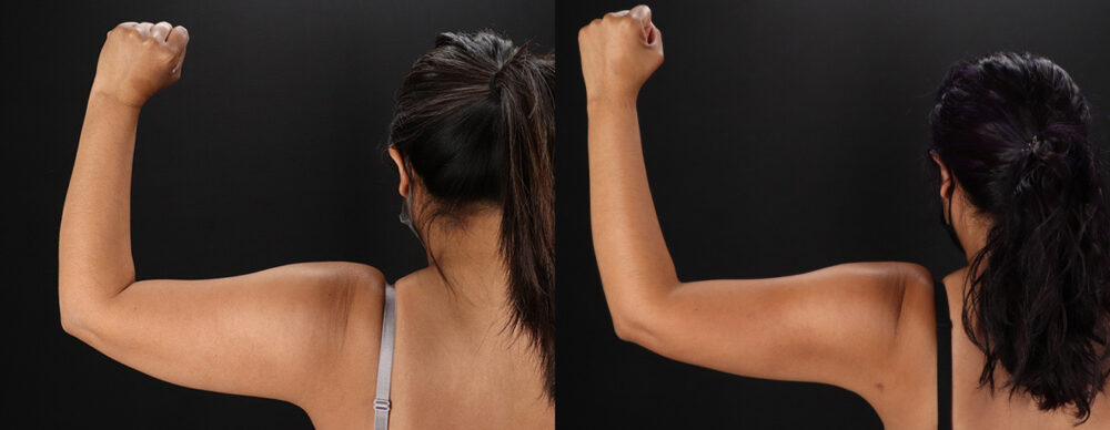 Tummy Tuck case #7472