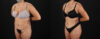 Tummy Tuck case #7472 slider thumbnail