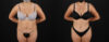 Tummy Tuck case #7472 slider thumbnail