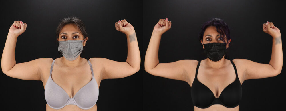 Tummy Tuck case #7472