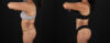 Tummy Tuck case #7472 slider thumbnail