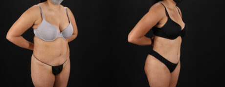 Tummy Tuck case #7472