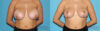 Breast Reduction case #7928 slider thumbnail