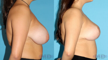 Breast Reduction case #7928