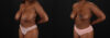 Breast Reduction case #8000 slider thumbnail