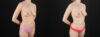 Fat Grafting to the Breast case #256214 slider thumbnail