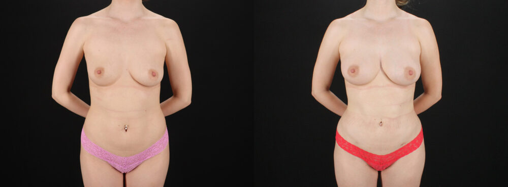 Fat Grafting to the Breast case #256214