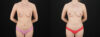 Fat Grafting to the Breast case #256214 slider thumbnail