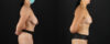 Breast Lift case #7792 slider thumbnail