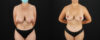 Breast Lift case #7792 slider thumbnail