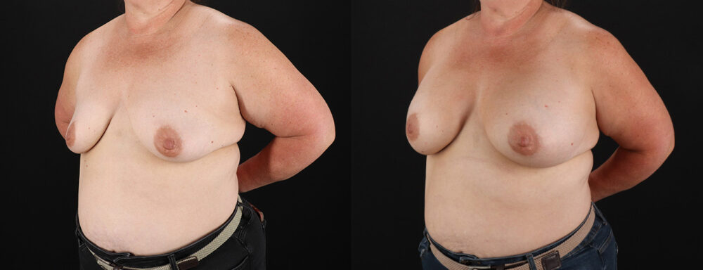 Breast Augmentation case #6450