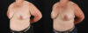 Breast Augmentation case #6450 slider thumbnail