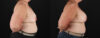 Breast Augmentation case #6450 slider thumbnail