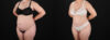 Brazilian Butt Lift case #5393 slider thumbnail