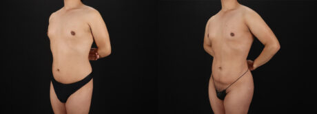 Brazilian Butt Lift case #5456