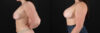 Breast Augmentation case #6426 slider thumbnail