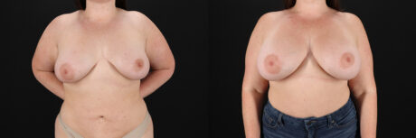 Breast Augmentation case #6426