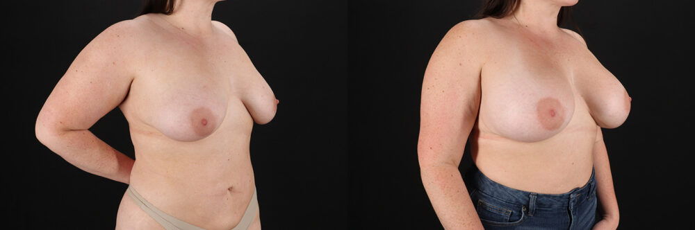 Breast Augmentation case #6426