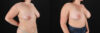 Breast Augmentation case #6426 slider thumbnail