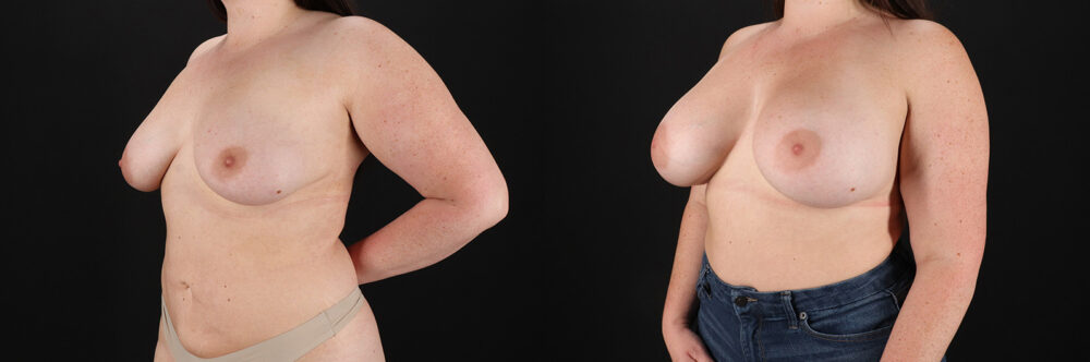 Breast Augmentation case #6426
