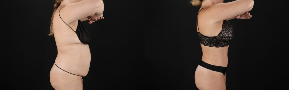 Tummy Tuck case #7621