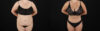 Tummy Tuck case #7621 slider thumbnail