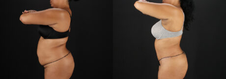 Tummy Tuck case #7616
