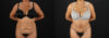 Tummy Tuck case #7616 slider thumbnail