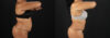 Tummy Tuck case #7616 slider thumbnail