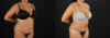 Tummy Tuck case #7616 slider thumbnail