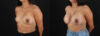 Breast Augmentation case #6456 slider thumbnail