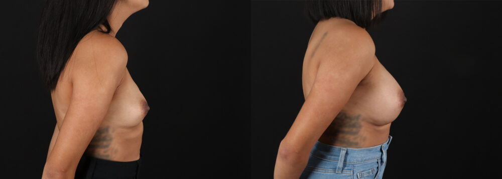 Breast Augmentation case #6456