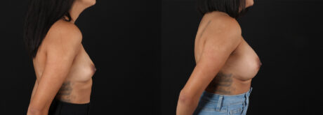 Breast Augmentation case #6456