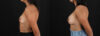 Breast Augmentation case #6456 slider thumbnail