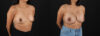 Breast Augmentation case #6456 slider thumbnail