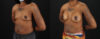 Breast Augmentation case #6432 slider thumbnail