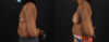 Breast Augmentation case #6432 slider thumbnail