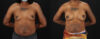 Breast Augmentation case #6432 slider thumbnail
