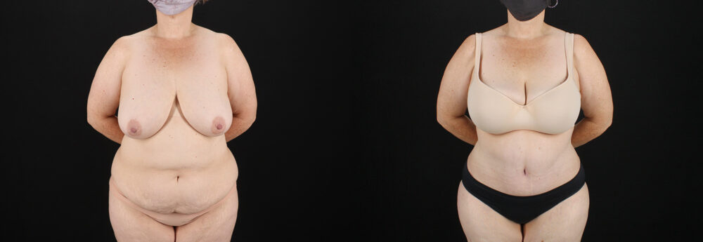 Tummy Tuck case #7615