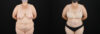 Tummy Tuck case #7615 slider thumbnail