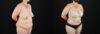 Tummy Tuck case #7615 slider thumbnail