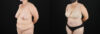 Tummy Tuck case #7615 slider thumbnail