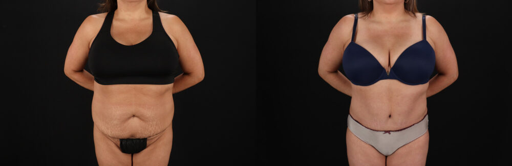Tummy Tuck case #7625