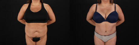 Tummy Tuck case #7625