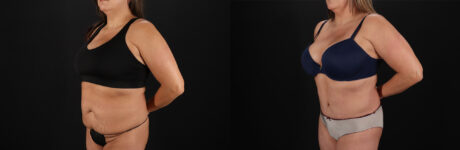 Tummy Tuck case #7625
