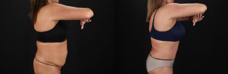 Tummy Tuck case #7625