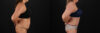 Tummy Tuck case #7625 slider thumbnail