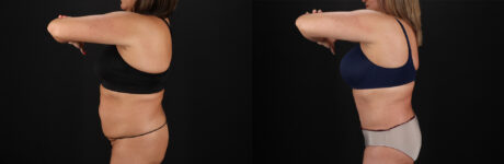 Tummy Tuck case #7625