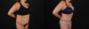 Tummy Tuck case #7625 slider thumbnail
